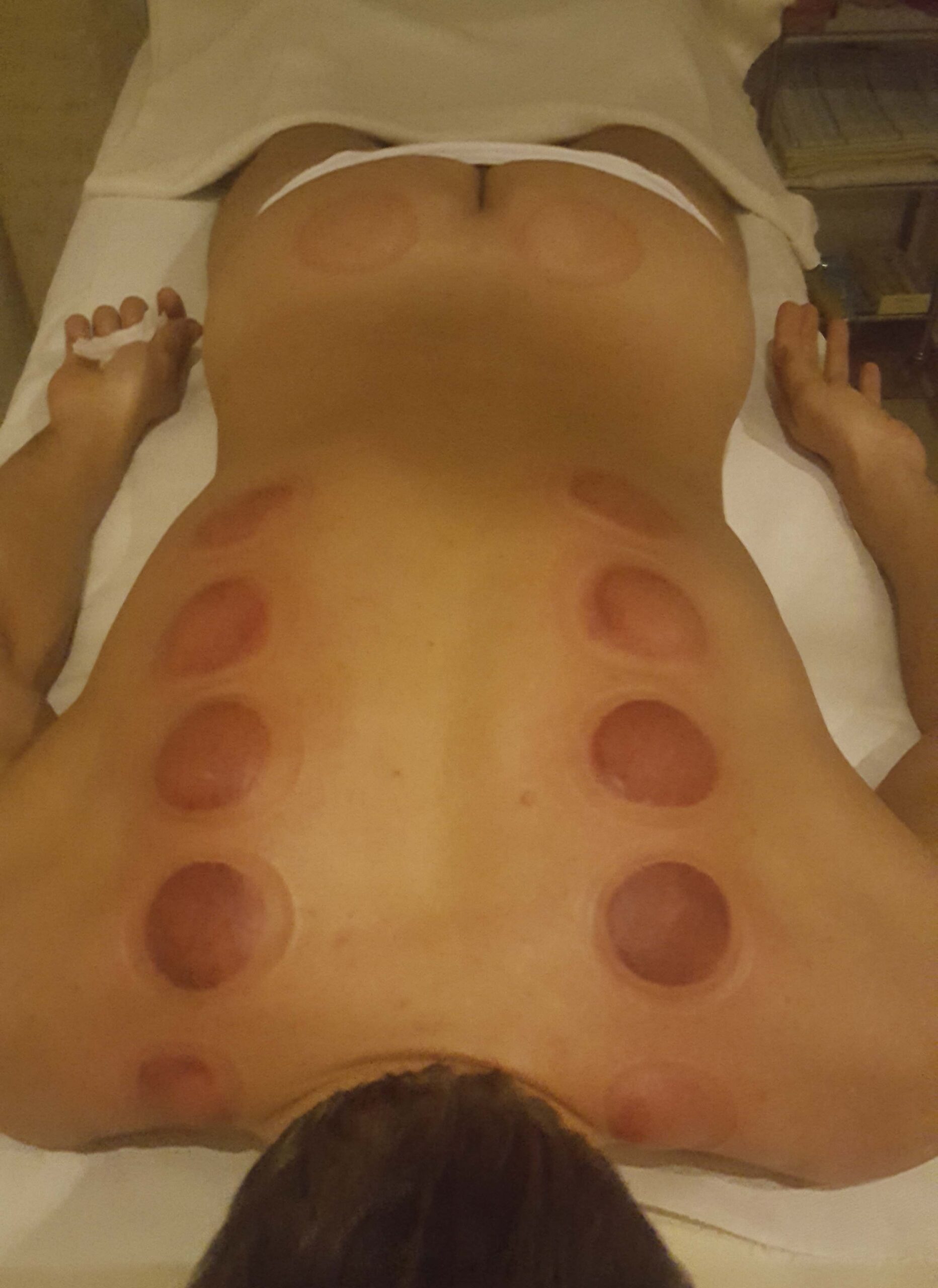 Köpölyözés_5